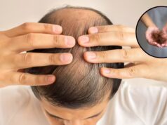 Hair Fall Remedy: झड़ते बाल और गंजेपन से हैं परेशान? सेलिब्रिटी हेयर स्टाइलिस्ट ने बताया प्याज-लहसुन और सरसों तेल का खास नुस्खा
